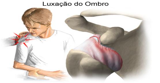 Luxação do Ombro ou Luxação Gleno Umeral INTRODUÇÃO Oque é Luxação Gleno Umeral? Luxação é o termo empregado quando há perda de contato entre os ossos que compõem uma articulação.