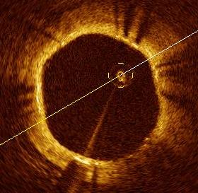 Covered malapposed strut Uncovered struts Hyperplasia