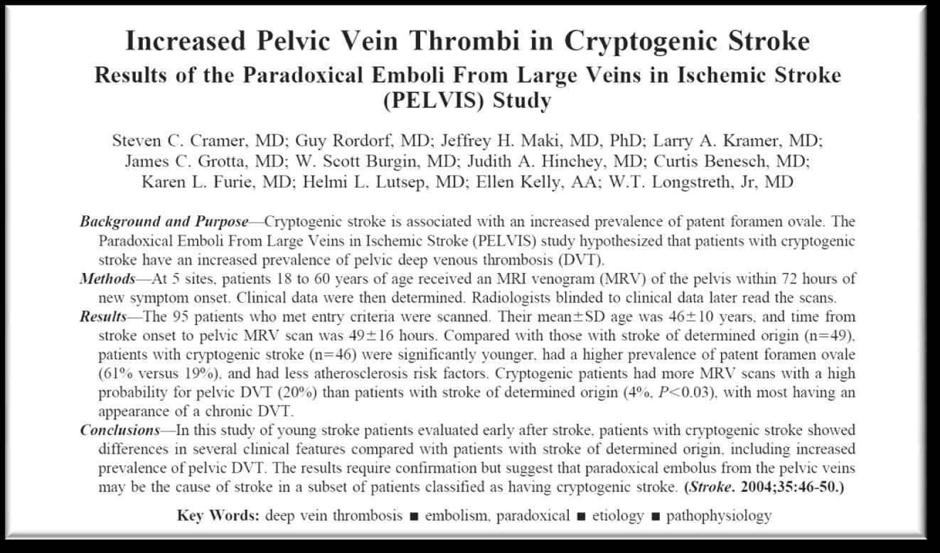 AVC isquêmico X FOP - Embolia Paradoxal AVC criptogênico (n=46): Mais jovens (< 55 a) Prevalência de FOP: 61% Menos