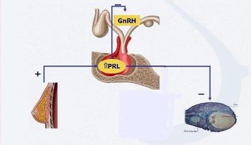 Hiperprolactinemia e Infertilidade Pulsatibilidade GnRH Diminuição LH / FSH