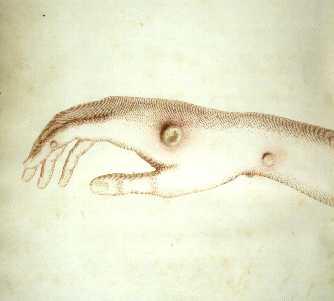 Em 14/05/1796, usando material com cowpox da mão da ordenhadeira Sarah