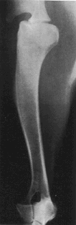 Radiografia do ombro e braço em projeção médiolateral Posicionamento da articulação do