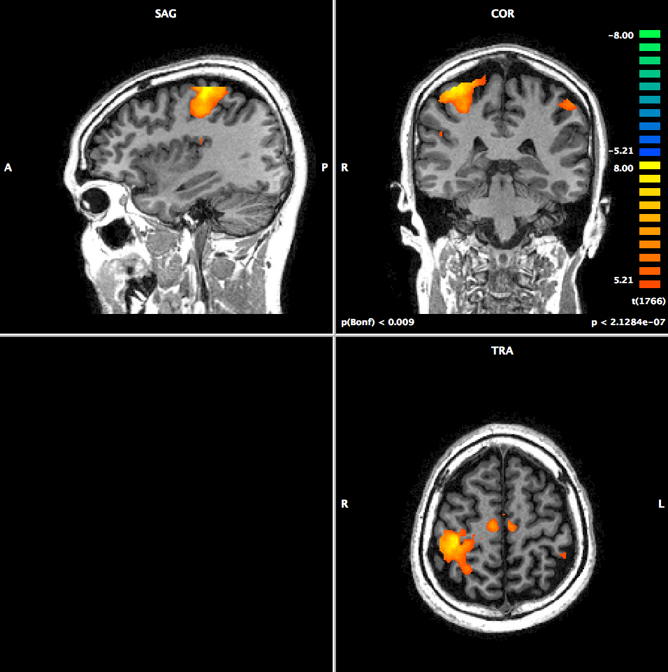 98 Controle (a) Paciente (b) Figura 50. Mapas de fmri em representação planar, nos cortes Sagital, Coronal e Axial.