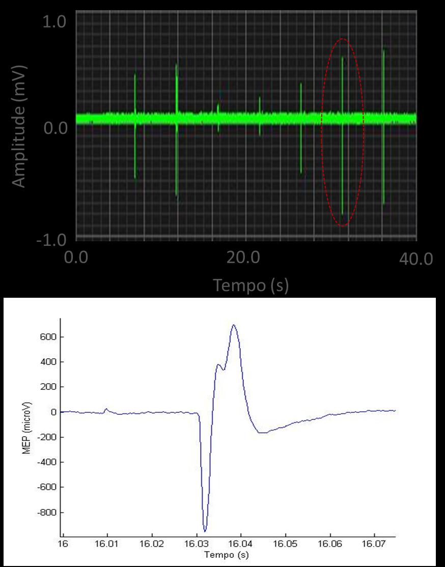 15 (a) (b) Figura 5. Exemplo de uma aquisição contínua do sinal de EMG em um exame de TMS. É interessante observar a variação de amplitude dos MEP durante a aquisição.