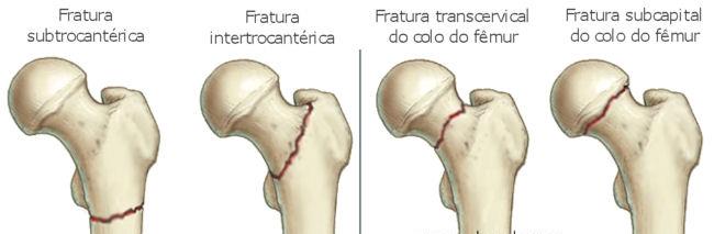 3 osteoporose secundária, por sua vez, relaciona-se a uma vasta lista de enfermidades e drogas implicadas na gênese ou exacerbação da doença (CUBAS et al, 2006). Fonte: http://www.sambemat.com.