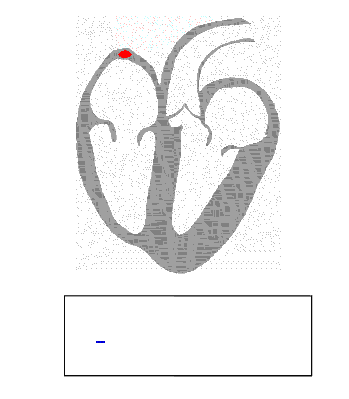 ECG de repouso Derivações acometidas Localização do IAM Provável Coronária Envolvida V1, V2, V3. Ântero-septal ADA ou ramo diagonal V1 a V4.