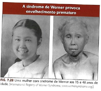 Xeroderma pigmentosum envelhecimento precoce aumento na incidência de câncer Falha no mecanismo de reparação do DNA causado pela luz UV Síndrome de Werner Doenças