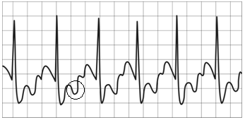 Figura 13 Figura 16 ST em morfologia de parábola contínua (Esquerda). A distância entre o posto de intersecção entre as linhas A e B (Direita), até o ponto J não deve exceder 0,05 mv (-0,5 mm).