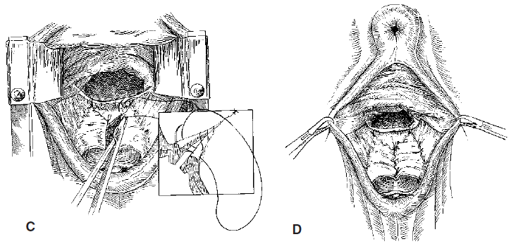 78 e se estender caudalmente até 2 a 3 cm cranial a vulva. As bordas da sutura são excisadas com tesoura e aproximadas em padrão contínuo de sutura com fio absorvível 2-0 (Figura 5).