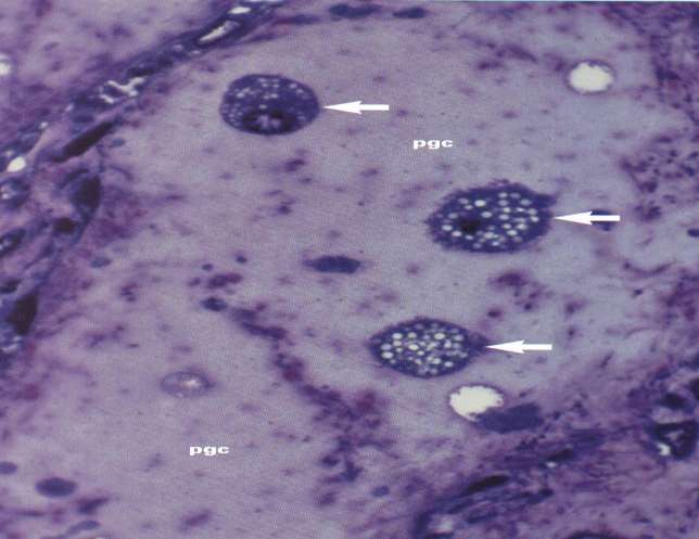 infecção): Coronária com íntima espessada com células