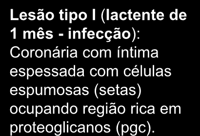 Prevenção - Nunca é Cedo Demais Aterosclerose inicia