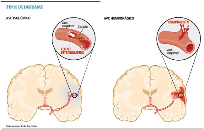 1. ACIDENTE VASCULAR CEREBRAL 1.1. DEFINIÇÃO Segundo o Portal da Saúde (2012), o AVC, também vulgarmente conhecido por trombose, consiste numa doença neurológica causada pela diminuição súbita de