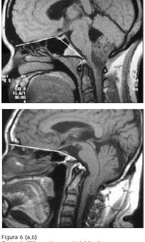 ÂNGULO BASAL DA WELCHER Corte de RM no plano sagital (a), observa-se o ângulo basal da Welcher formado por uma linha entre o násion e o