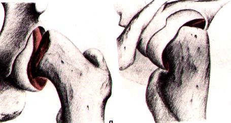 GRAU II: deslocamento da cabeça em relação ao colo femoral inferior a 1/3 do diâmetro da cartilagem epifisária.