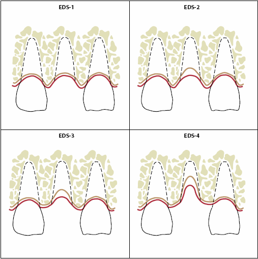 20 Figura 1- Classificação dos defeitos alveolares pós-exodontia. EDS-1: alvéolo íntegro com biótipo espesso. EDS-2: médio dano no alvéolo, com perda menor do que 2mm no osso proximal.