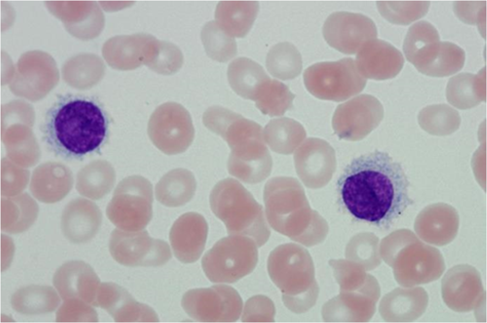 Tricoleucócitos (hairy cells) A leucemia de células cabeludas é uma neoplasia crônica da linhagem B que apresenta linfócitos morfologicamente distinguíveis.