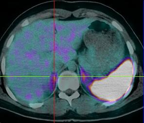 TNE: DIAGNÓSTICO 68 Ga-DOTA-NOC PET/CT CAPTAÇÃO FISIOLÓGICA Hipófise Baço Fígado Glândulas suprarrenais Pâncreas (+++