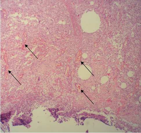 Ricciardi Correção de hérnia abdominal com tela envolta por tecido fibroso estudo em ratos Wistar 199 Figura 6 - Figura 7 - Presença de neovascularização em grande quantidade em animal do grupo