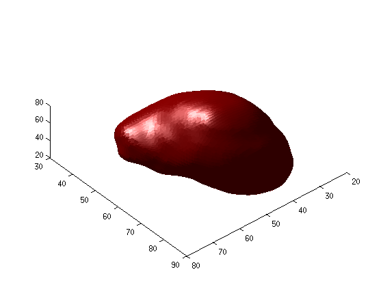 CAPÍTULO 5. METODOLOGIA (a) (b) Figura 5.14: Resultados obtidos através do FVGG. a) um dos últimos cortes onde aparece o fígado, b) um dos cortes localizado próximo do centro do fígado. Figura 5.15: Volume obtido com diferentes perspetivas.