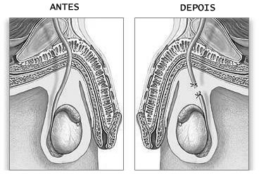 Métodos Definitivos (irreversíveis) Métodos Definitivos (irreversíveis) São métodos impedem definitivamente a fertilidade do homem e da mulher.