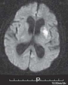 Afasia Ø Neglect Ø Hemianópsia Ø Desvio oculocefálico Siverman,