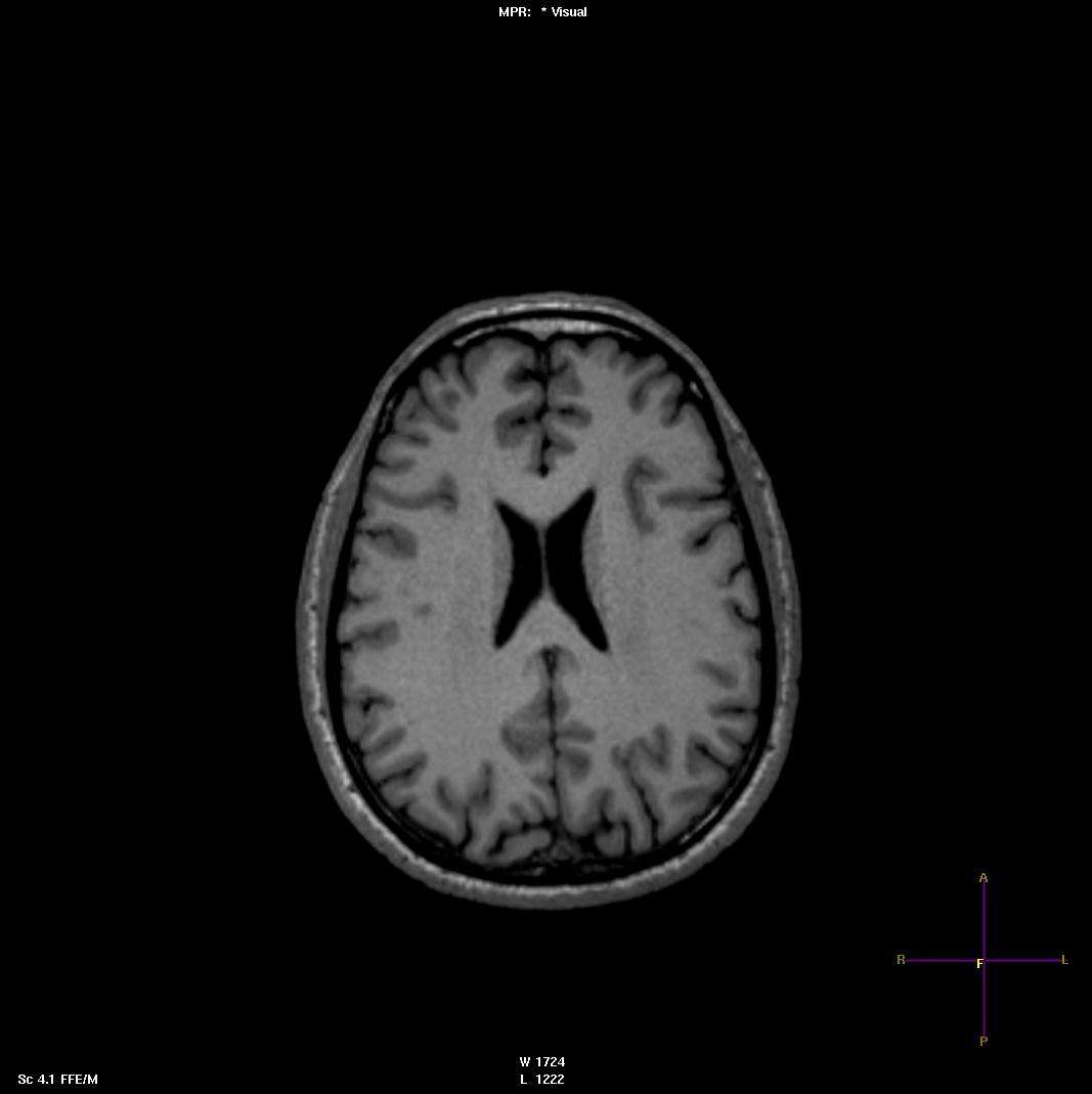 Transtorno Bipolar Poucos Episódios - 53 anos