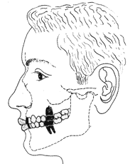 21 3.4 ASPECTOS ORTODÔNTICOS: OCLUSÃO DENTÁRIA Como já visto anteriormente, a respiração bucal tem causas específicas diversas. Estas vão interferir significativamente na formação do esqueleto facial.