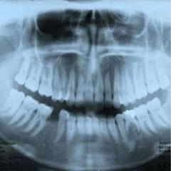 Anexo 27 - Imagem radiográfica de agenesia dos dentes 3.5 