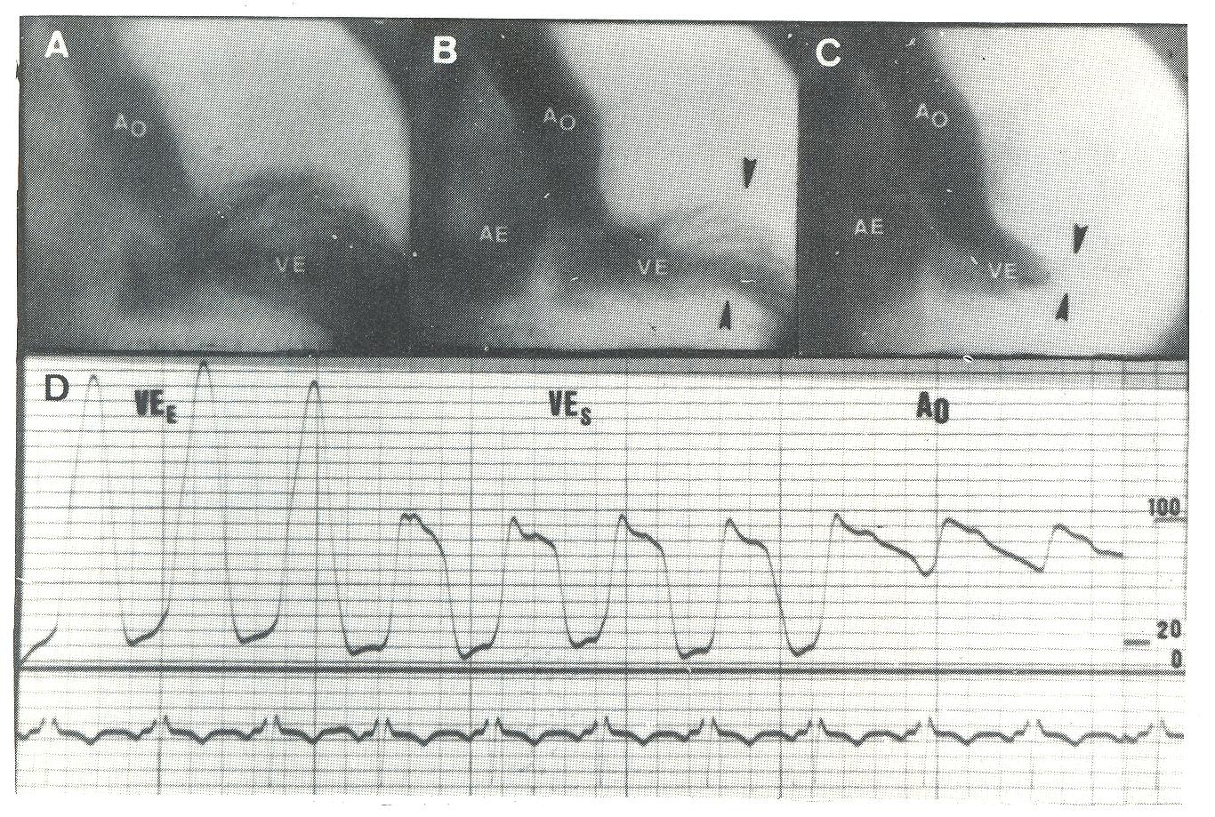 Miocardiopatia