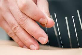 A acupuntura é uma técnica oriunda da Medicina Tradicional Chinesa. Privilegia a concepção sistêmica, funcional e multiconectiva, resultando em abordagem integrativa do organismo humano.