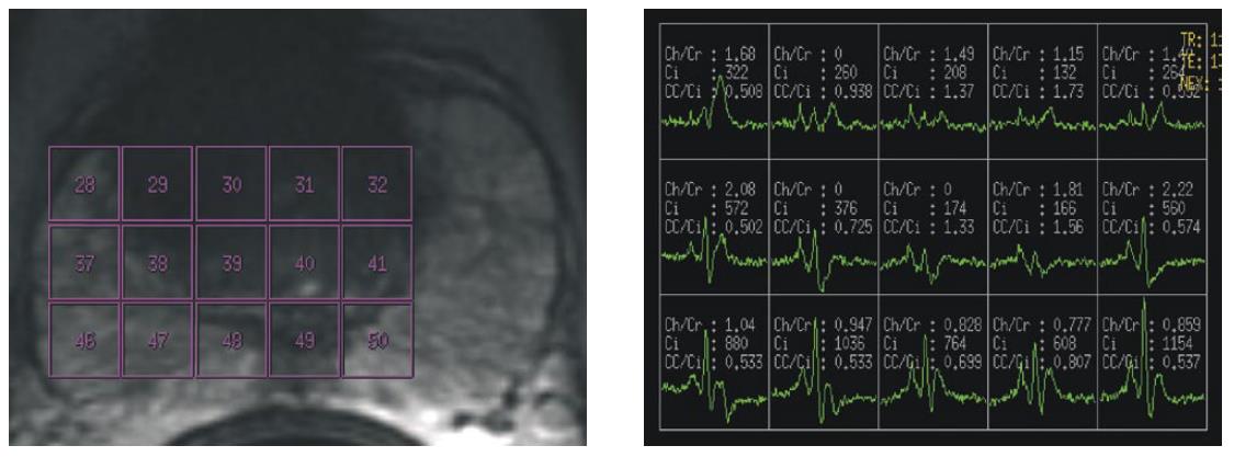 12 Os protocolos utilizados variam de instituição para instituição, no entanto Melo 2009, apresenta em seu artigo um modelo de protocolo para o exame de RM e espectroscopia, explicitando os dados a