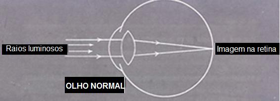 Visão Normal Imagem na retina No olho míope, os raios luminosos são focalizados antes da retina.