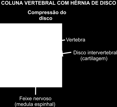 A dismetria dos membros inferiores, defeitos biomecânicos dos pés, traumatismo, sedentarismo, atitude mental e hábitos errados, Indumentária inadequada, ganho de peso corporal, levantar e carregar