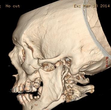 48 Figura 36 (a)- Janela de osso onde visualiza-se fratura temporo pariental- occipital a direita.