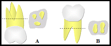 II.6.ii Defeitos de Furca Definição: Carnevale G., Pontoniero R. e Lindhe, J. (2010)(2) e Sims T.N., et al.