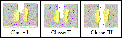 Classe I: Perda horizontal de suporte periodontal que não excede um terço da largura dentária.