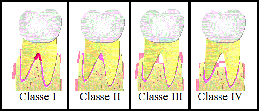 igual ou superior à dimensão vestíbulo lingual do dente deve concluir que existe um defeito de furca de classe III.