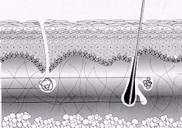 Receptores nervosos da pele e mecanismos de defesa percebem a punturação como uma lesão. Uma aceleração da indução do colágeno natural da pele.