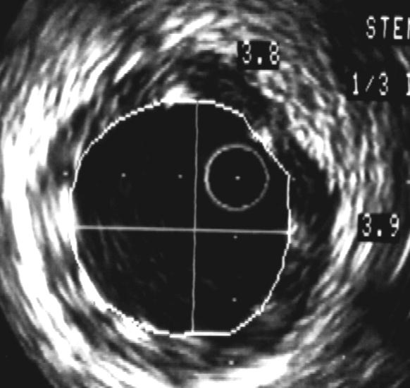 DISTAL REF EXPRESS 4.0/12mm ÁREA LUM 12.