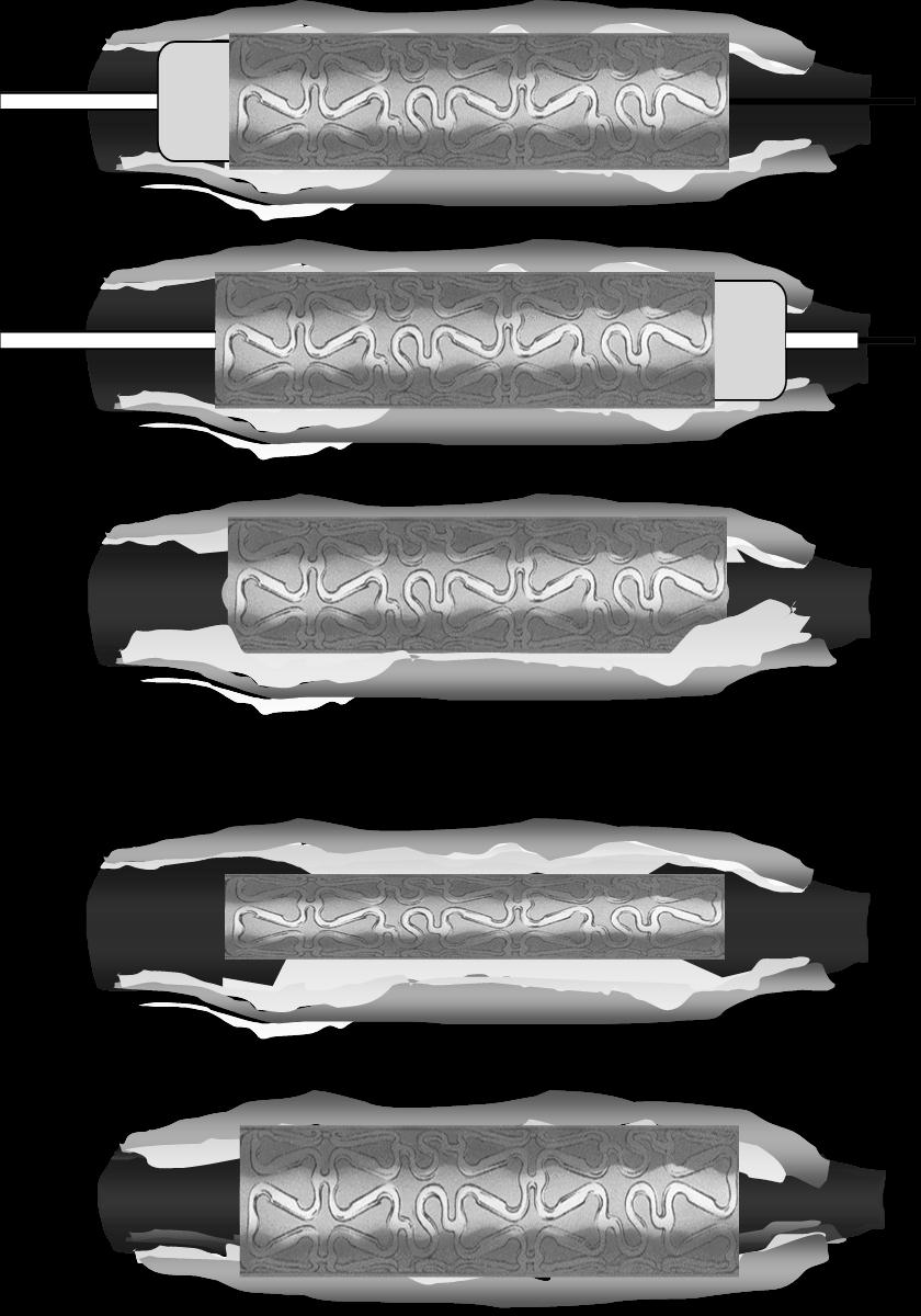 Longitudinal Geomiss Balloon Injury Proximal Distal Edges Edges