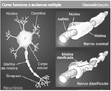 Fonte: http://patologiadeorgaosesistemas.blogspot.com/010/09/esclerose-multipla.