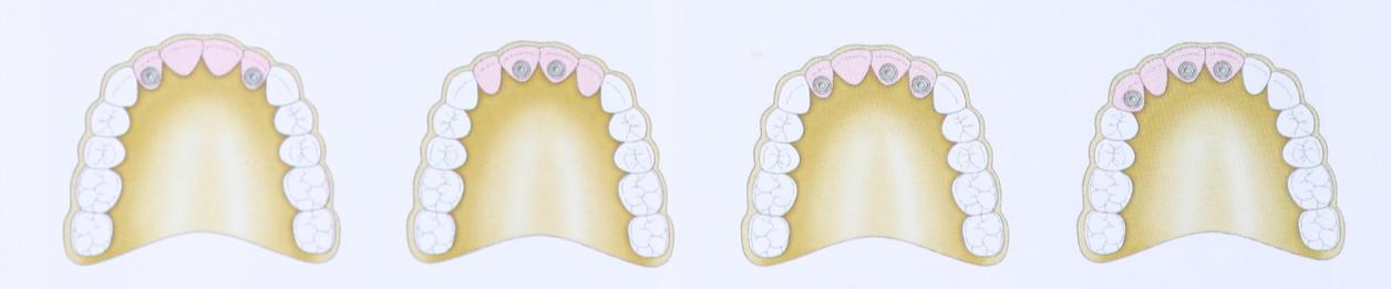 Entretanto, em espaços menores do que 28,0 mm, pode-se reabilitar 4 elementos até com dois implantes (Figura 12) (BIANCHINI, 2008).