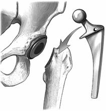 Artroplastia da anca a) b) c) d) e) f) Figura 2.