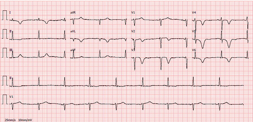 Síndrome coronária aguda Eletrocardiograma Alterações da onda T Onda bifásica Inversão simétrica da onda T Pseudonormalização da onda T ABC of