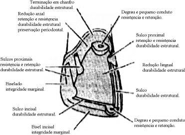 Preparo de uma coroa parcial ¾. Características de uma coroa parcial ¾ com pino modificada e a função desempenhada por elas.