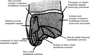 Coroa parcial 4/5 com blindagem de cúspide (molar inferior).