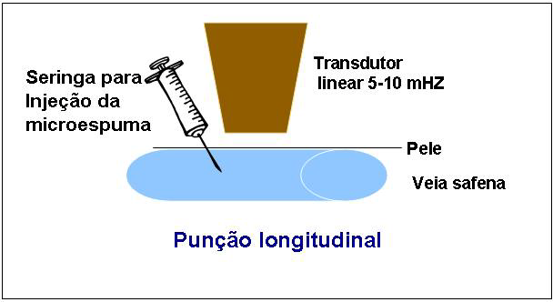 40 punção da veia foi realizada com dispositivo com asas 3 com o paciente em posição ortostática, facilitando assim a visibilização da mesma.