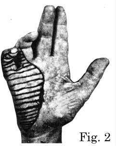 Levantar Miopático ou Sinal de Gowers: Mão em Garra Cubital ou mão do pregador: lesão n.