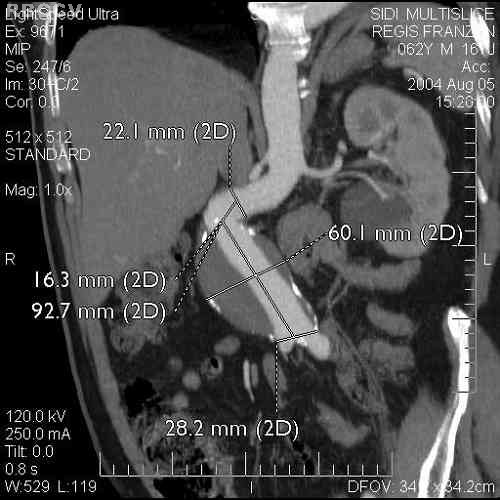 16. EVAR Trial participants. Endovascular aneurysm repair versus open repair in patients with abdominal aortic aneurysms (EVAR 1 Trial): Randomized controlled trial. Lancet 2005;365:2179 86.