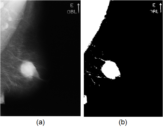 CAPÍTULO 3. MINERAÇÃO E PROCESSAMENTO DE IMAGENS 67 etapa que antecede a segmentação. Na Figura 3.12(a) tem-se uma imagem de mamografia apresentando uma lesão benigna. E na Figura 3.